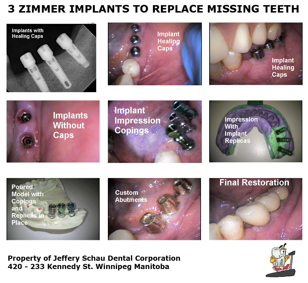 3-zimmer-implants
