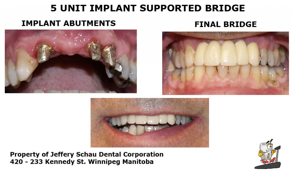 5-unit-implant-bridge-ridgelap1-1024×611
