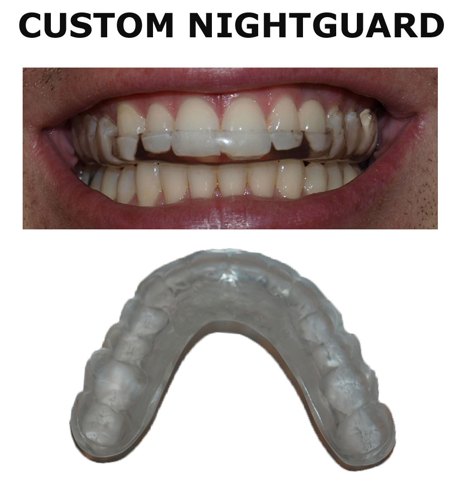 Custom-Nightguard