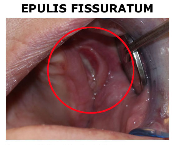 Epulis-Fissuratum1