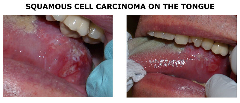 Squamous-cell-carcinoma